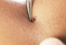 How to avoid tick bites in your yard or while hiking in the woods, and what to do if one starts feasting on you